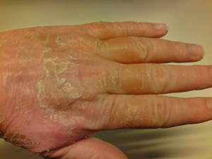 Hand 14/1-2014 (efter 19 dygn)